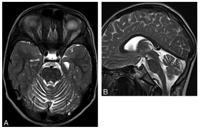 Ataxia MRI scan