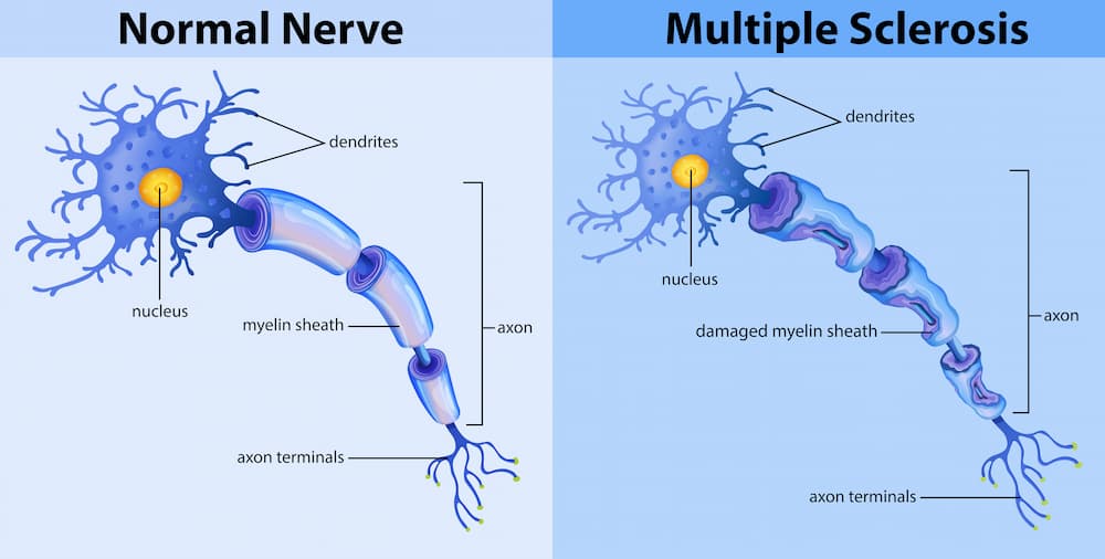 Normal nerve and multiple sclerosis