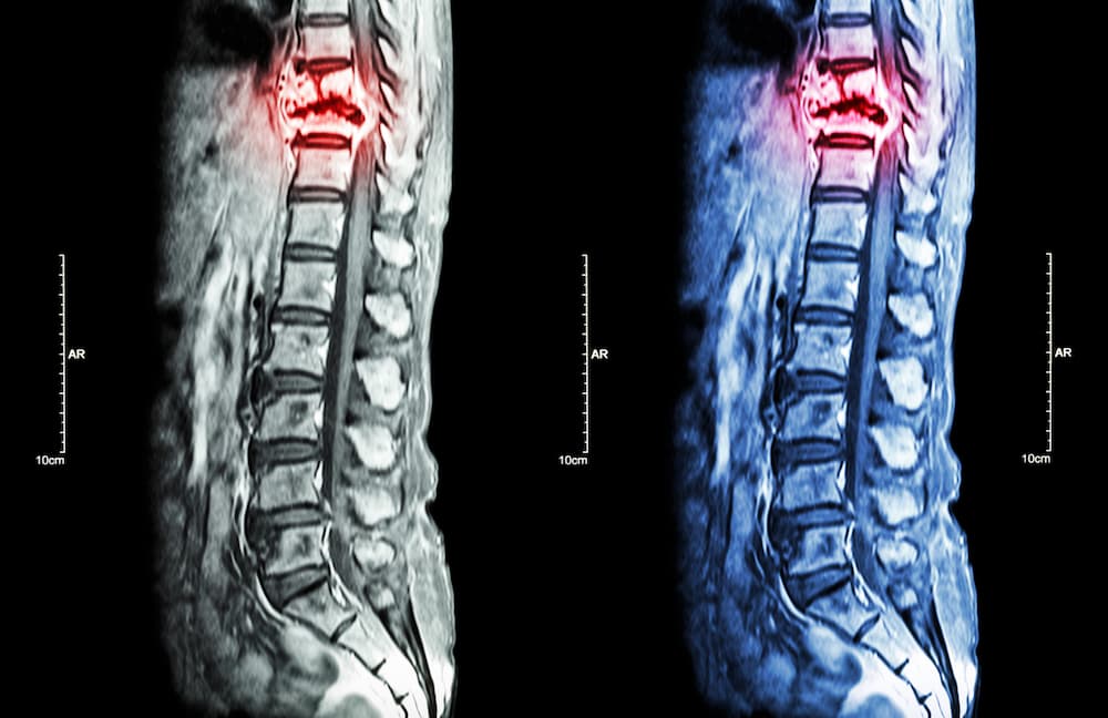 How does a spinal cord injury affect the brain