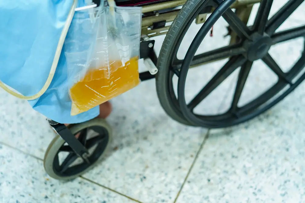 Asian middle-aged lady woman patient sitting on wheelchair with urine bag