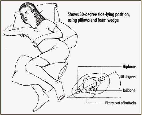 Pressure sores prone areas affected by body position on bed. (a).