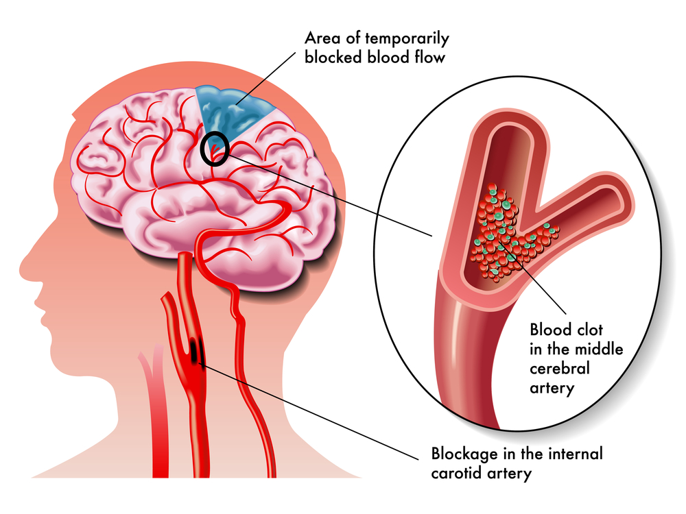 Effects of the TIA transient ischemic attack