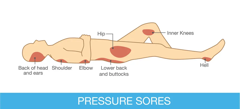 Pressure sores prone areas affected by body position on bed. (a).